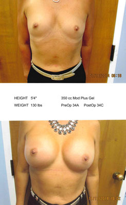 Bilateral Breast Augmentation before and after