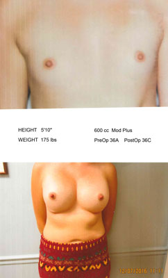 Bilateral Breast Augmentation with Dr. Saunders