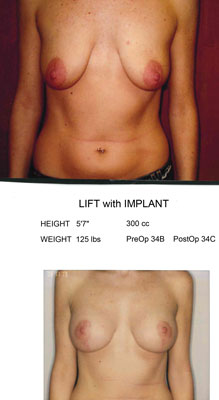 Mastopexy Lift with Implant
